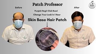 Skin Base Hair Patch  Skin Base Hair System  Natural Look in 1 Hours [upl. by Ninahs]