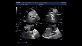 Ultrasound Video showing the Cirrhosis of the liver [upl. by Levi]