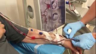 Dialysis connection of a patient with an arteriovenous fistula [upl. by Esinyt]