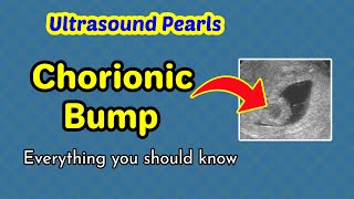 Ultrasound Pearls Chorionic Bump [upl. by Tony]