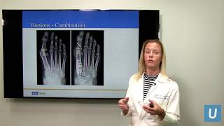 Bunions amp Hammertoes  Joan Williams MD  UCLAMDChat [upl. by Eiboh]