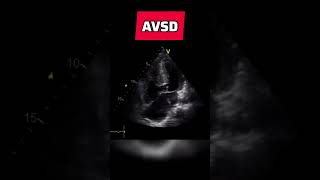 Atrioventricular septal defect  congenital heart defect echocardiography AVSD [upl. by Crow3]