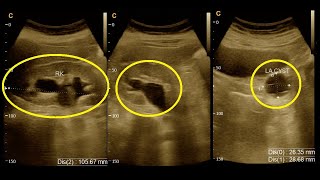 Grade  3  Hydroureteronephrosis  Ultrasound  Report  Amader hospital  Ultrasonography report [upl. by Ednarb967]