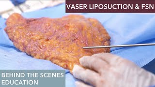 How does Vaser Liposuction work [upl. by Alakim]