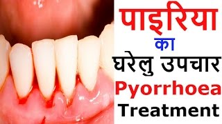 पायरिया के घरेलू उपाय और नुस्खे  Natural Home Remedies amp Treatment for Pyorrhea [upl. by Pas]