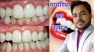 Payriya ka ilaj  Treatment of gingivitis amp periodontitis [upl. by Dirfliw347]