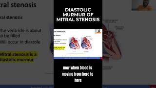 Diastolic Murmur of Mitral Stenosis  MCCQE1 [upl. by Truscott]