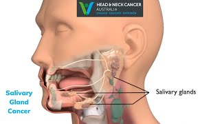 Salivary Gland Cancer  What Is It What are the Symptoms and Treatment Head and Neck Cancer [upl. by Brynne]