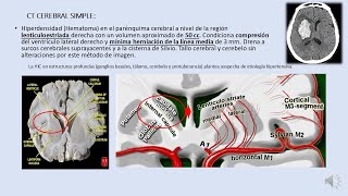 Hemorragia Cerebral  Protocolos de Emergencia hipertensiva y Hemorragia Cerebral Espontánea [upl. by Sherrer]