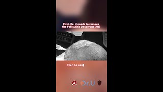 Folliculitis Decalvans and Acne Keloidalis Patient Visits Dr U [upl. by Zeph140]