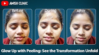 Peeling Procedure Step by Step  Skin peeling Day by Day  Peeling Results by Dr Vijay Kumar [upl. by Durman]