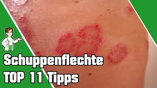 Schuppenflechte entfernen und heilen  TOP 11 Tipps 💯 [upl. by Rose878]