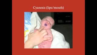 Surgery of Cyanotic CHDs  CRASH Medical Review Series [upl. by Tish]