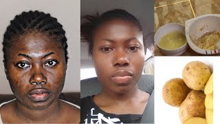 7 Days glowing skin challenge  Potato juice or Besan will give you flawless white skin [upl. by Etka910]