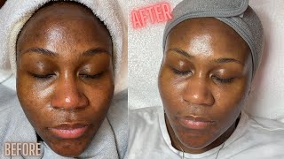 Salicylic Acidbenefits  Get glowing spotless skin  Remove acne amp Pigmentation  ZITCARE S Gel [upl. by Anneliese]