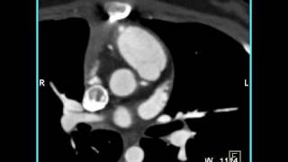 Cardiac Occluded RIMA Graft in a patient with bypass for aberrant coronary artery 2 of 4 [upl. by Merola]