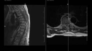 How to differentiate Degenerative disk disease and spinal infection [upl. by Bernelle973]