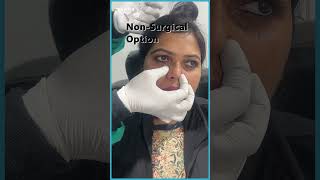 Under Eye Filler Before and After  Best Techniques Revealed  AWISH Clinic [upl. by Aiyot209]