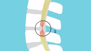 What is Lumbar Stenosis Symptoms Causes amp Benefits of Ultrasonic Technology [upl. by Allissa]