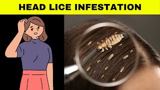 Head Lice Infestation  Causes Signs And Symptoms Diagnosis And Treatment [upl. by Clary]