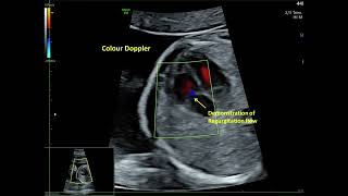 Trivial Tricuspid Valve Regurgitation  Fetal Echo [upl. by Etteiluj]