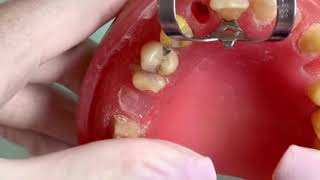 Isolamento absoluto em Endodontia passo a passo [upl. by Sirtimid]