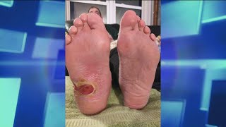 How Diabetic Foot Ulcers Occur [upl. by Aneertak]