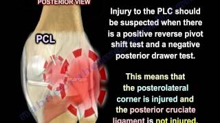 Dial Test posterolateral corner PCL injuries  Everything You Need To Know  Dr Nabil Ebraheim [upl. by Meadow]