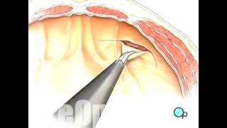 Hérnia Inguinal Cirurgia por Videolaparoscopia [upl. by Nakasuji147]