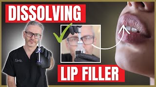 Dissolving Lip Filler  How to use Hyaluronidaise  Filler Reversal [upl. by Nangatrad835]