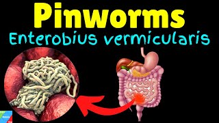 Pinworms Threadworms Symptoms Causes Treatments Life Cycle – Enterobius vermicularis [upl. by Ihcego]