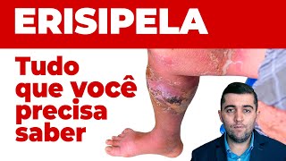 Erispela como curar sinais e sintomas e como prevenir suas complicações Guia completo da doença [upl. by Asiluy]