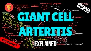 Giant cell artheritis Pathogenesis EULAR Diagnostic criteria Treatment of Temporal arteritis [upl. by Koressa]