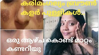 കരിമംഗല്യം pigmintation brown spot 100 effective Home Remedy one week challenge [upl. by Laroy]