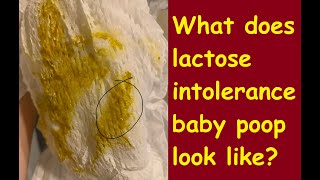 What does lactose intolerance baby poop look like [upl. by Maram]