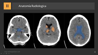 Cómo describir una TC de Cerebro [upl. by Naziaf]