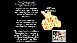 Alpha DefensinTests Ortho Surgeons Think About  Everything You Need To Know  Dr Nabil Ebraheim [upl. by Adile]