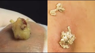 Satisfying Acne and Blackhead Extraction Compilation  Ultimate Pimple Popping Relaxation [upl. by Tracey]