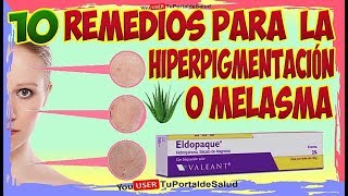 10 Remedios para la Hiperpigmentación de la Piel o Melasma  Tratamientos Para Melasma [upl. by O'Neil167]