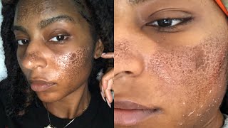 How I Ruined my skin Burned  Scarring amp Hyperpigmentation  Fraxel iamLindaElaine [upl. by Leibrag]