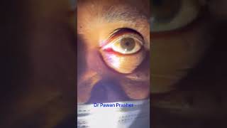 RAPD Relative Afferent Pupillary Defect [upl. by Idnerb377]