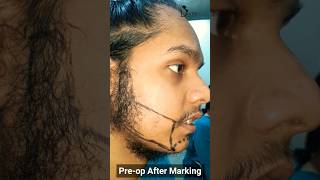 Beard Transplant Results 2022  Hair Transplant Results 2022 beardtransplant hairtransplantindia [upl. by Aivilys]