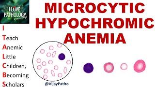 MICROCYTIC HYPOCHROMIC ANEMIA Causes Mechanism amp Approach [upl. by Nnyleimaj]