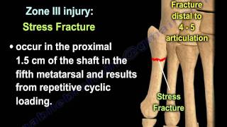 Proximal Fifth Metatarsal Fractures  Everything You Need To Know  Dr Nabil Ebraheim [upl. by Trebled640]