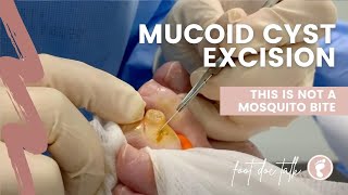 Mucoid Cyst Excision 👀 [upl. by George907]