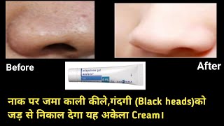 Adapalene gel Adaferin  01। कील और सफ़ेद दानों का इलाज Treatment for Blackheads amp Whiteheads [upl. by Herring]