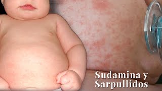 🔴 SARPULLIDO EN TU BEBE SUDAMINA O MILIARIA TODO LO QUE DEBES SABER [upl. by Arahs618]