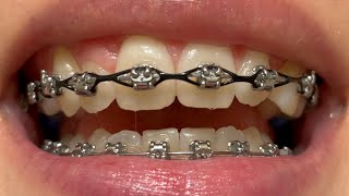 Adult Braces  20 Month Update [upl. by Edythe]