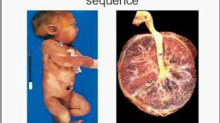 Medical School Pathology Chapter 10b [upl. by Allehc]