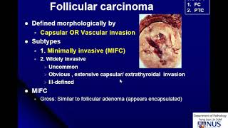 Thyroid Carcinoma Gross and Micro [upl. by Rodge]